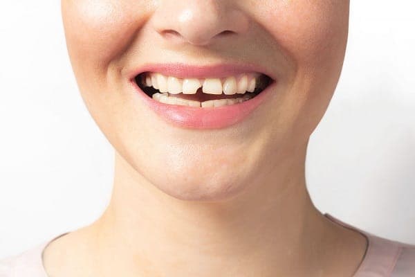 Dental repair options for cracked teeth showing bonding, crowns, and filling procedures