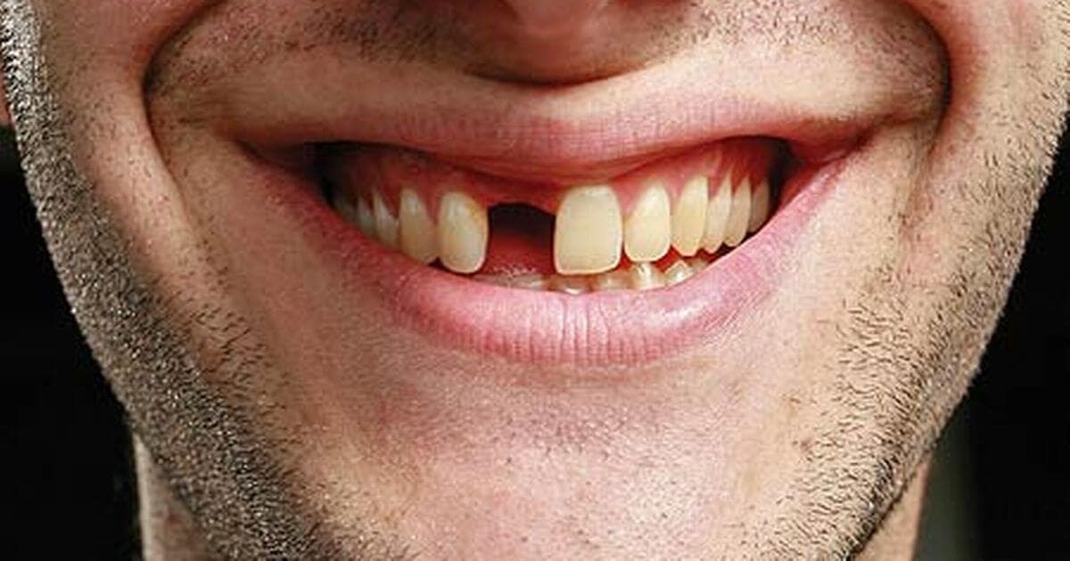 Illustration showing tooth loss and aging