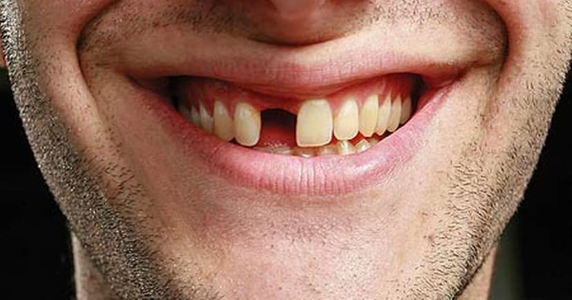 Illustration showing tooth loss and aging