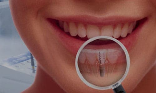 Dental Implants
