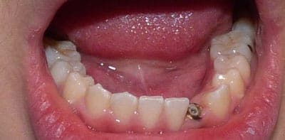 Before - Before treatment