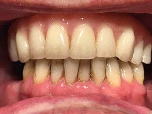 After - After treatment