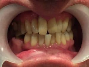 Before - Before treatment
