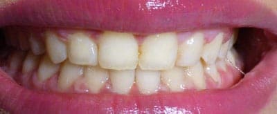 After - After treatment