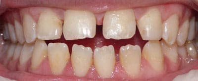 Before - Before treatment