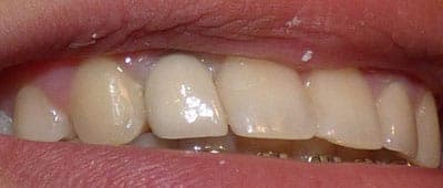 After - After treatment