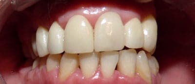 After - After treatment