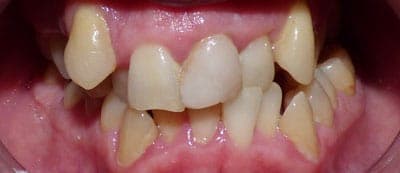 Before - Before treatment