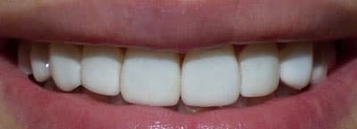 After - After treatment