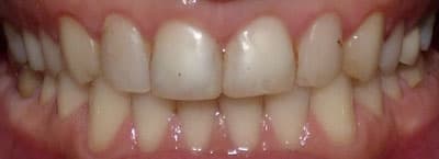 Before - Before treatment