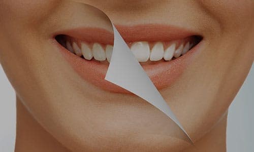 Veneers