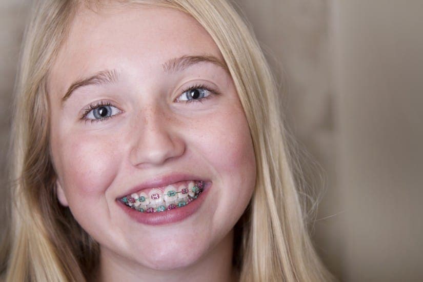 Orthodontic treatment with Invisalign clear aligners