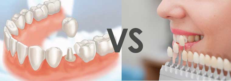 Comparison of dental veneers and crowns