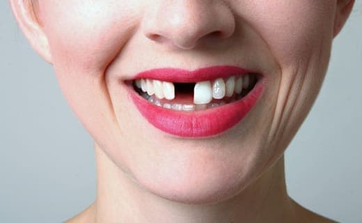 Dental extraction procedure showing surgical instruments and technique